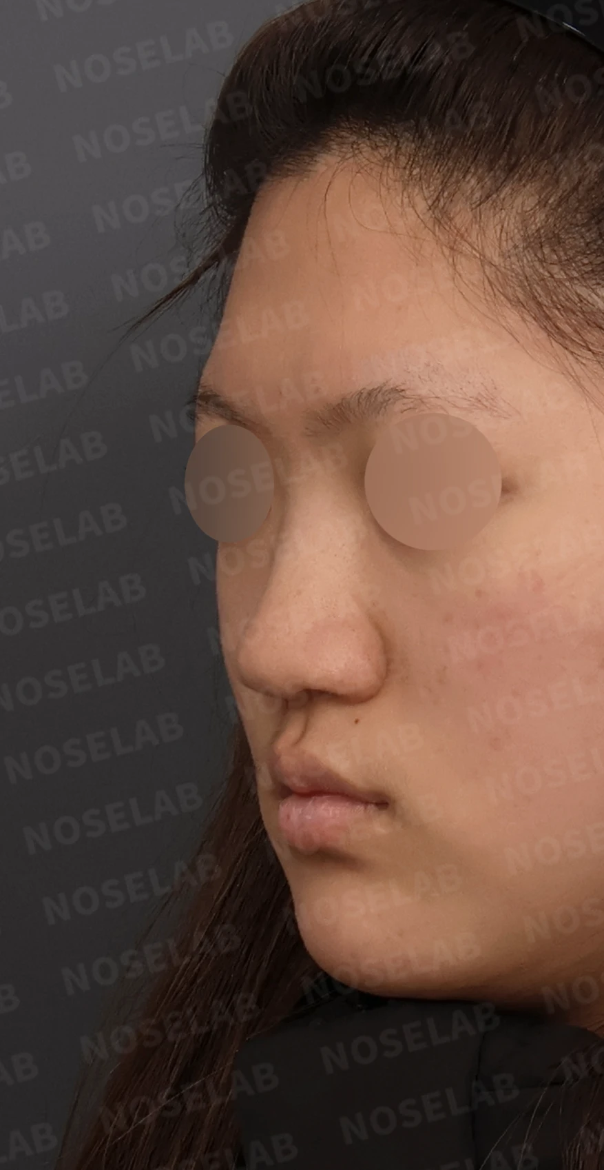 뭉툭한 코끝과 퍼진 코, 자가늑연골 비중격 연장술로 자연스럽게 교정 — 디자인 상담 정면, 좌측 측면, 비스듬한 측면 사진입니다.