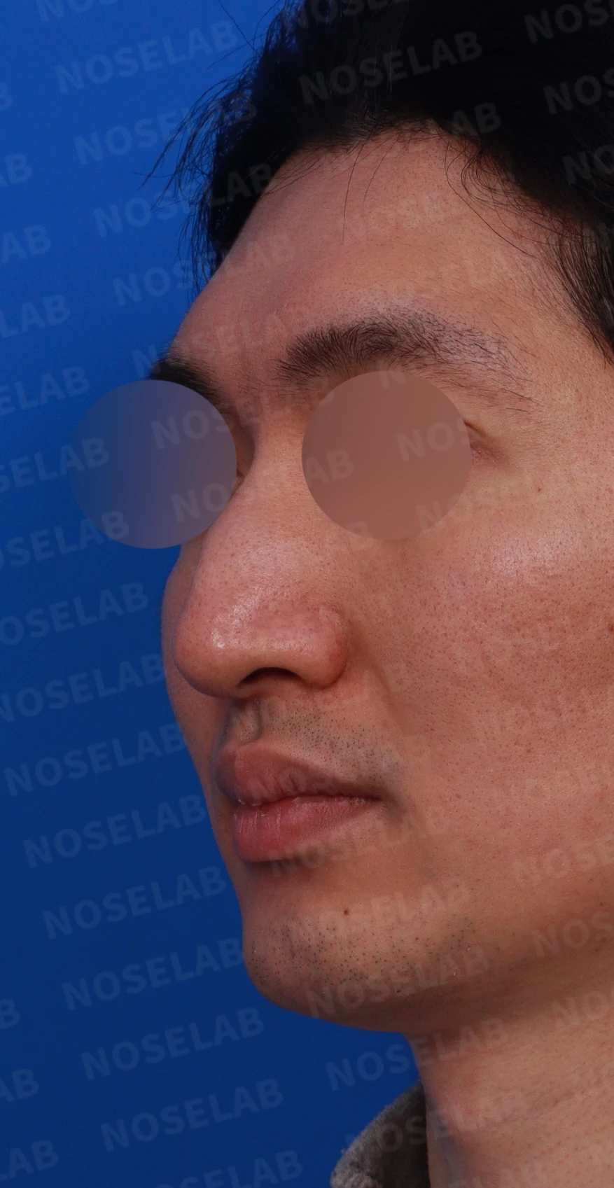 매부리코에 코막힘이 함께 오는 이유, 자가 늑연골만으로 하는 교정 방법 — 디자인 상담 정면, 좌측 측면, 비스듬한 측면 사진