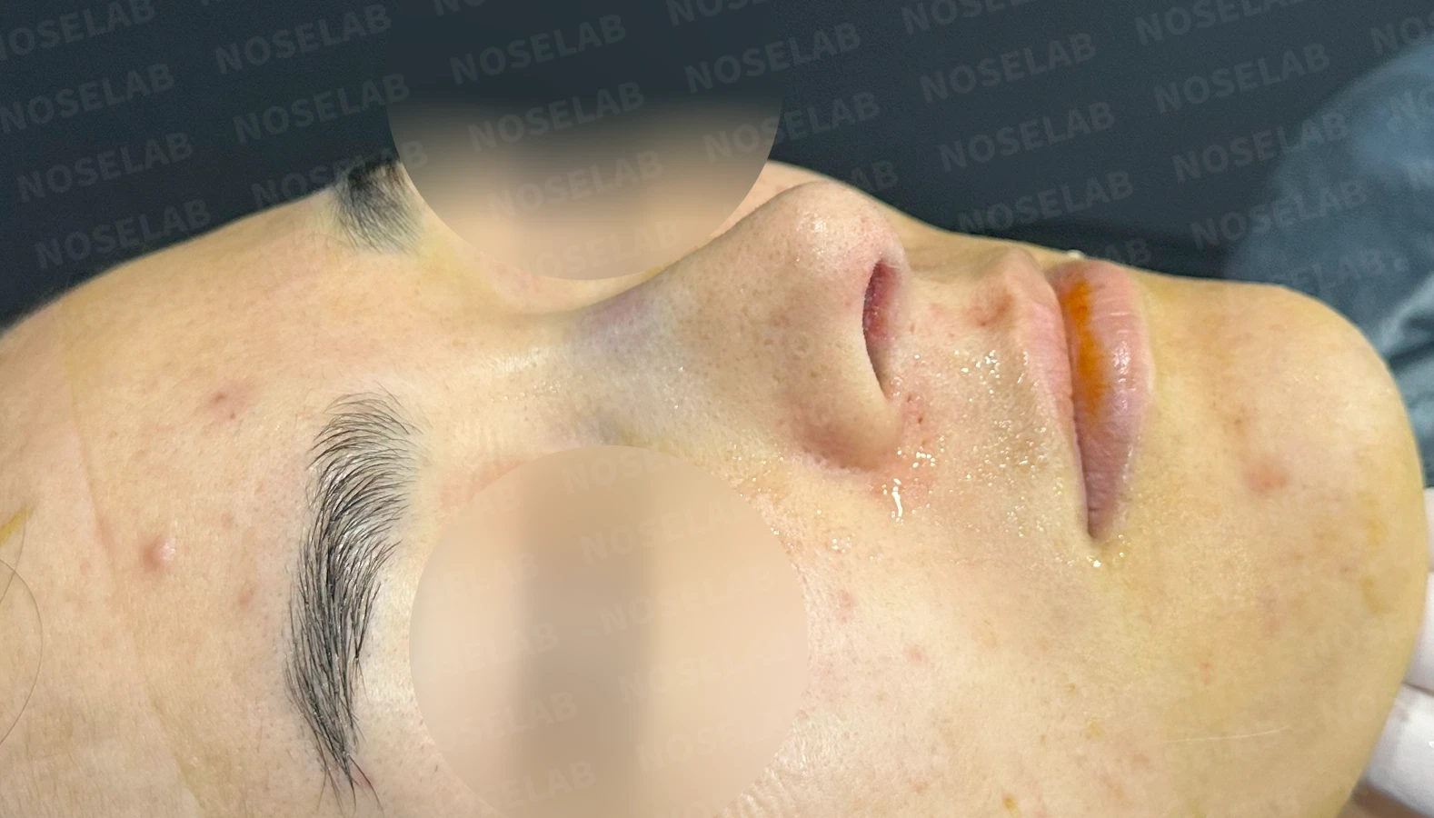 매부리코, 코막힘 개선 코성형 방법 — 수술 전 / 수술 직후 0일 직후 사진은 부기가 있는 상태로 최종 결과와 다를 수 있습니다.