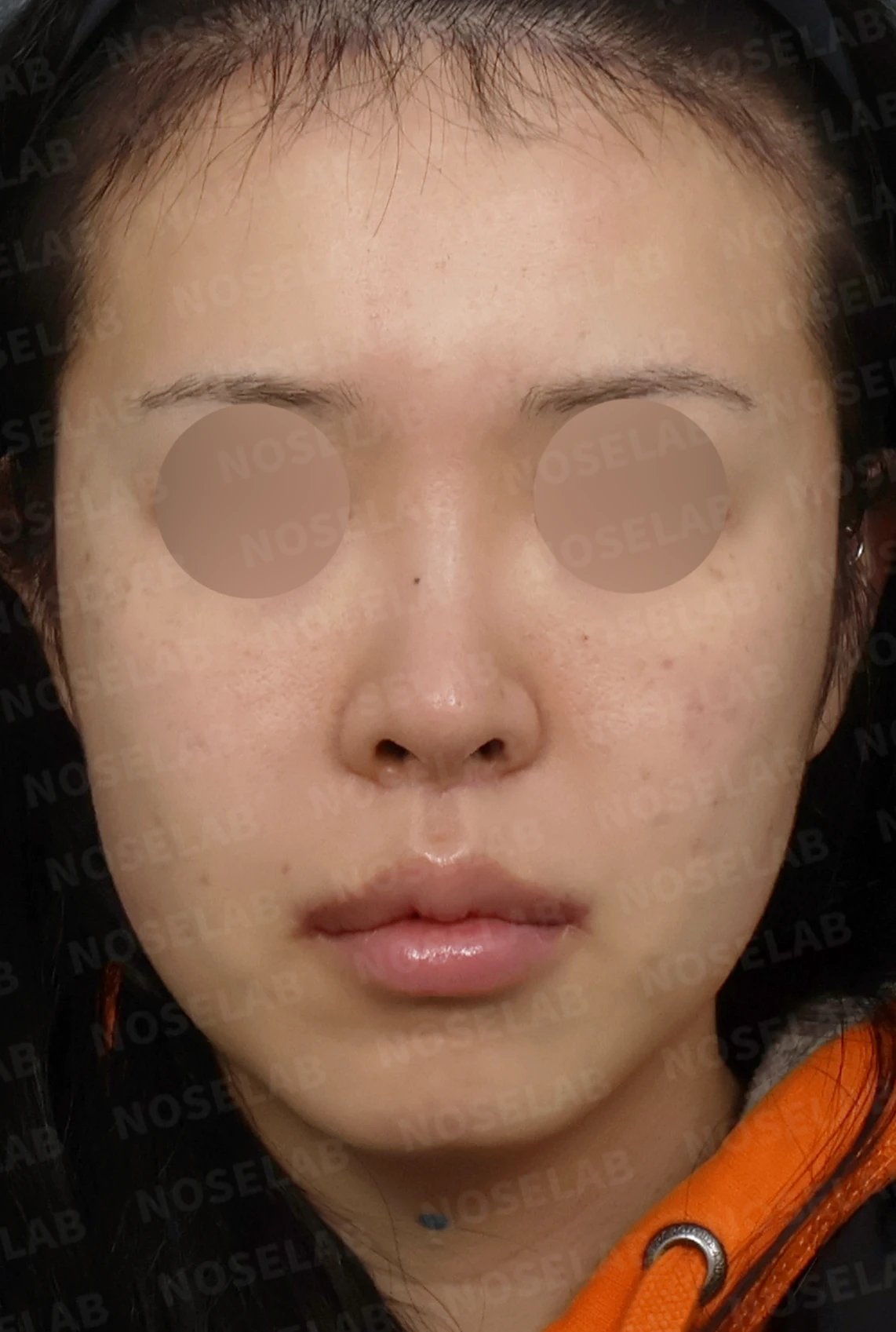 들린 코와 돌출입 개선, 자가늑연골로 화려한 직반라인 완성 — 디자인 상담 정면, 좌측 측면, 비스듬한 측면 사진입니다.
