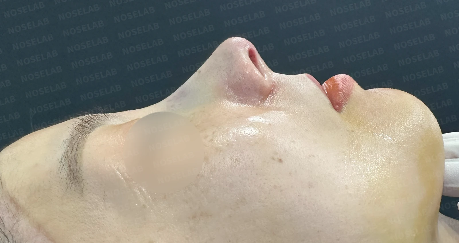 복코, 퍼진코 교정 방법 — 수술 전 / 수술 직후 0일 직후 사진은 부기가 있는 상태로 최종 결과와 다를 수 있습니다.