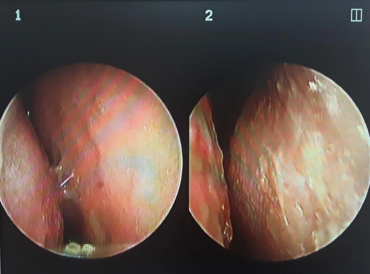 비염 수술 뒤에도 증상이 재발하는 이유, 휜 코를 함께 교정하는 방법 — 비내시경 사진