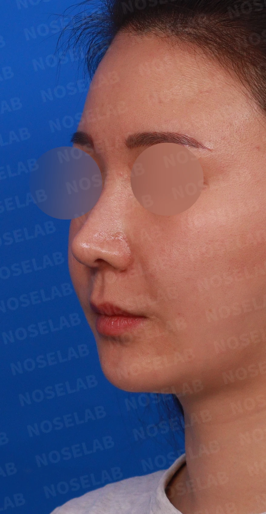 코가 휘어 보이고 비주가 한쪽으로 기우는 이유, 교정은 어떻게 하나 — 디자인 상담 정면, 좌측 측면, 비스듬한 측면 사진