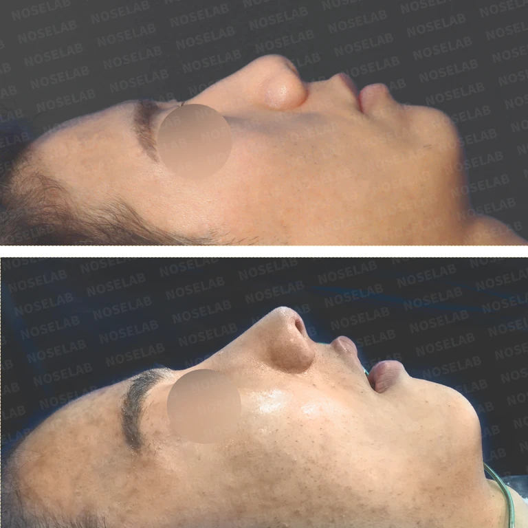 복코 교정과 비주 내리기를 함께 계획하는 방법 — 전후 비교