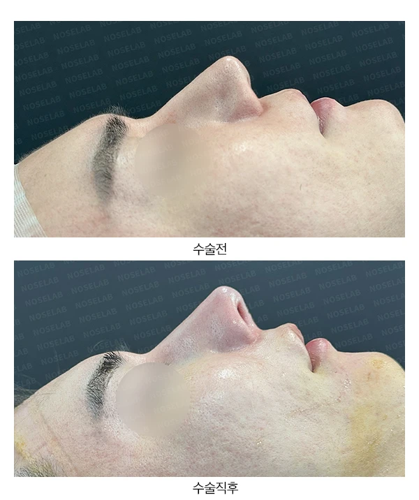 수술한 티가 나는 실리콘 보형물 교체 맞춤 코성형 방법 — 전후 비교