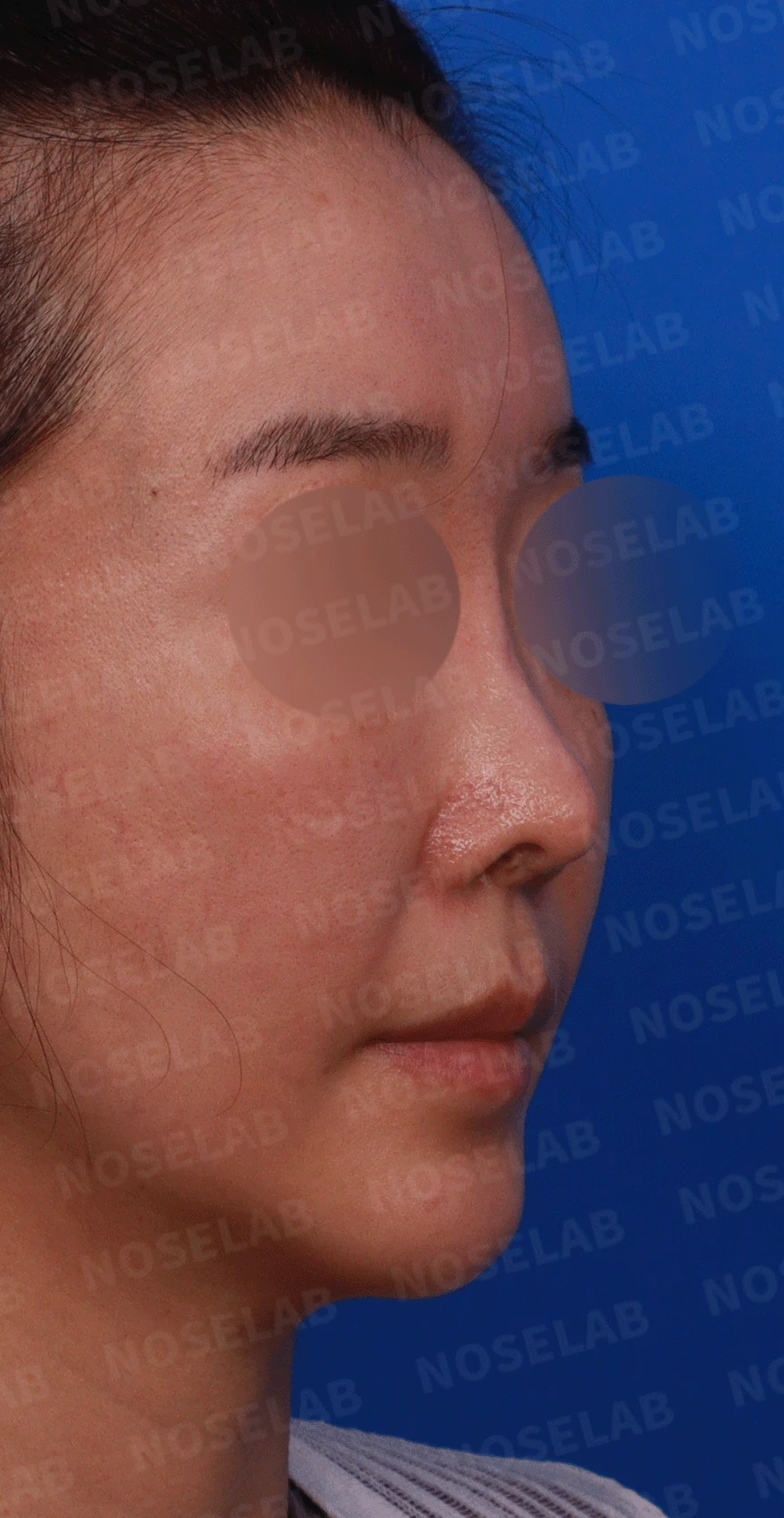 반복된 코재수술 뒤 안장코와 비밸브 협착이 생기는 이유, 전체 재건은 어떻게 하나 — 디자인 상담 우측 비스듬한 측면 , 측면 , 비공 사진입니다.
