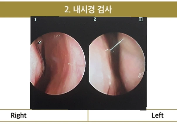 복코와 퍼진 코의 코성형 방법 — 코 내시경 사진 1. 우측 2. 좌측