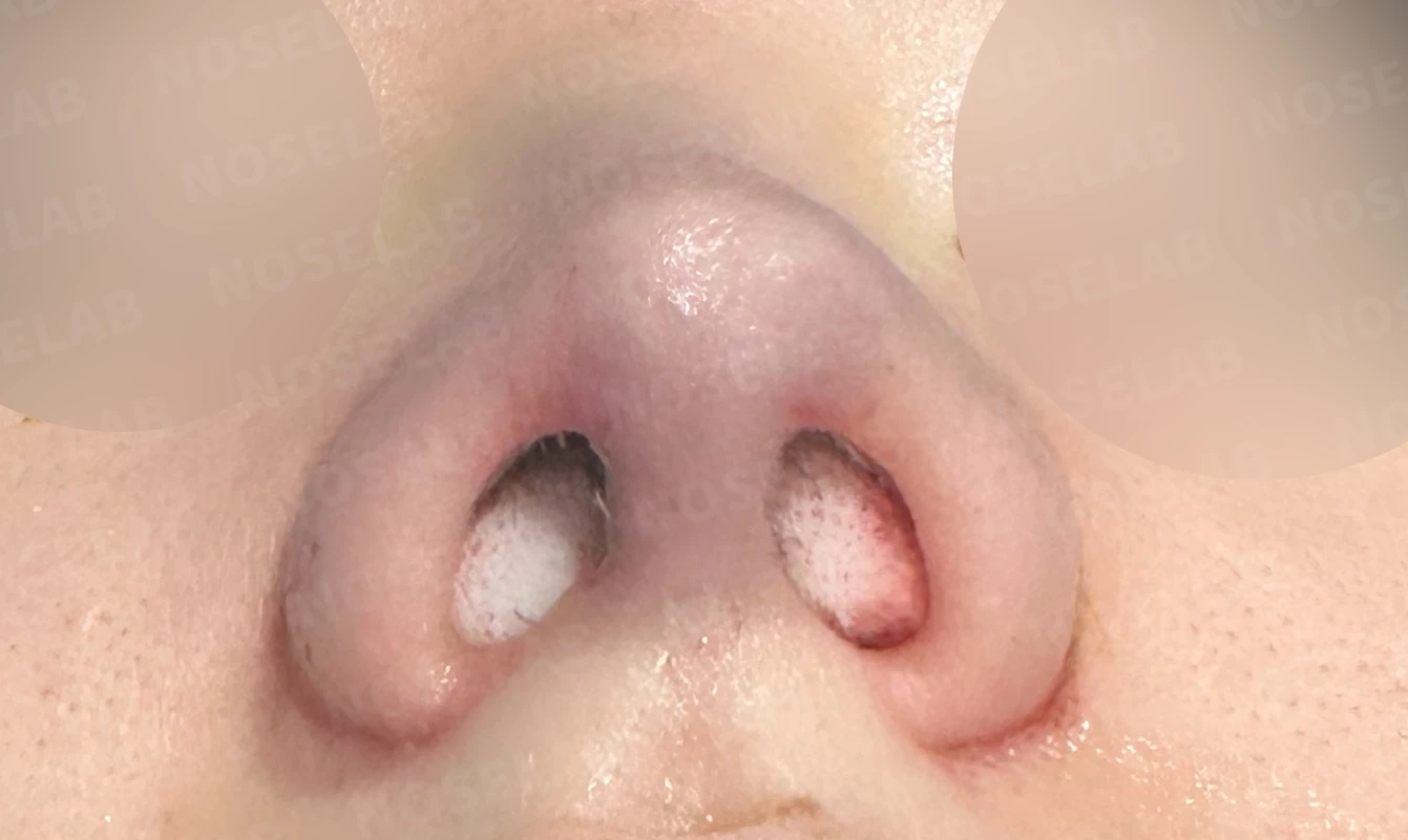 코끝이 퍼지고 입체감이 없어 보이는 이유, 복코 교정은 어떻게 하나 — 수술 직후 0일 비공 사진 직후 사진은 부기가 있는 상태로 최종 결과와 다를 수 있습니다.