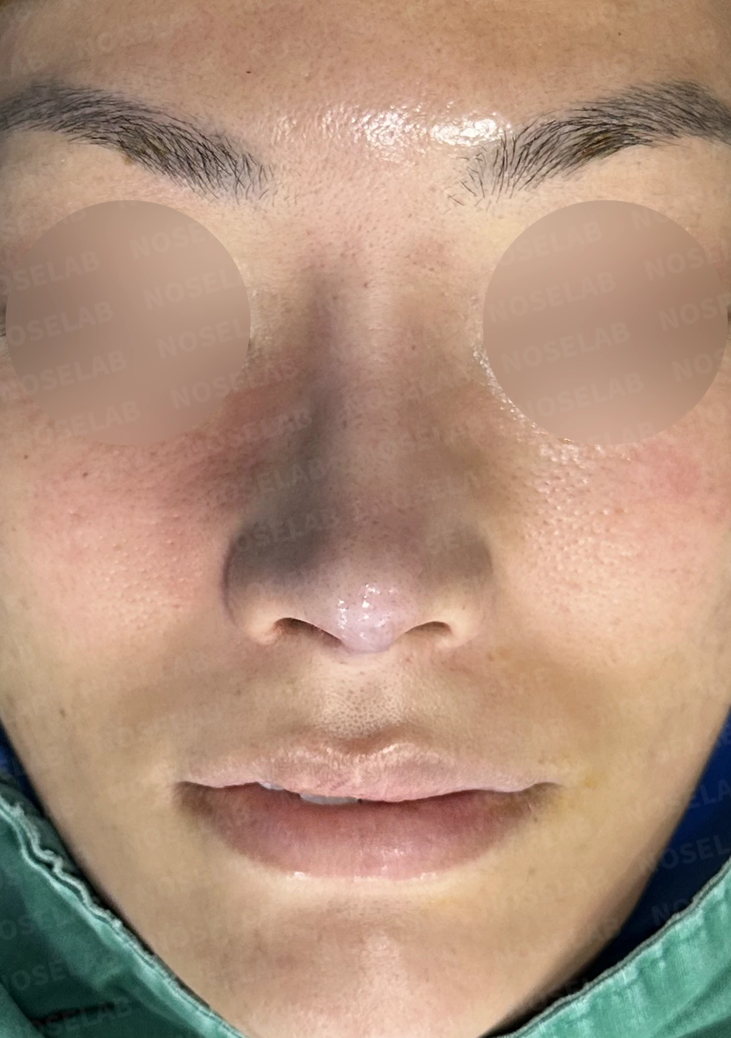 오래된 보형물 코의 코끝 지지력이 약해지는 이유와 비중격연장 재건 방법 — 수술 직후 0일 정면, 비스듬한 측면, 측면 사진입니다. 직후 사진은 부기가 있는 상태로 최종 결과와 다를 수 있습니다.