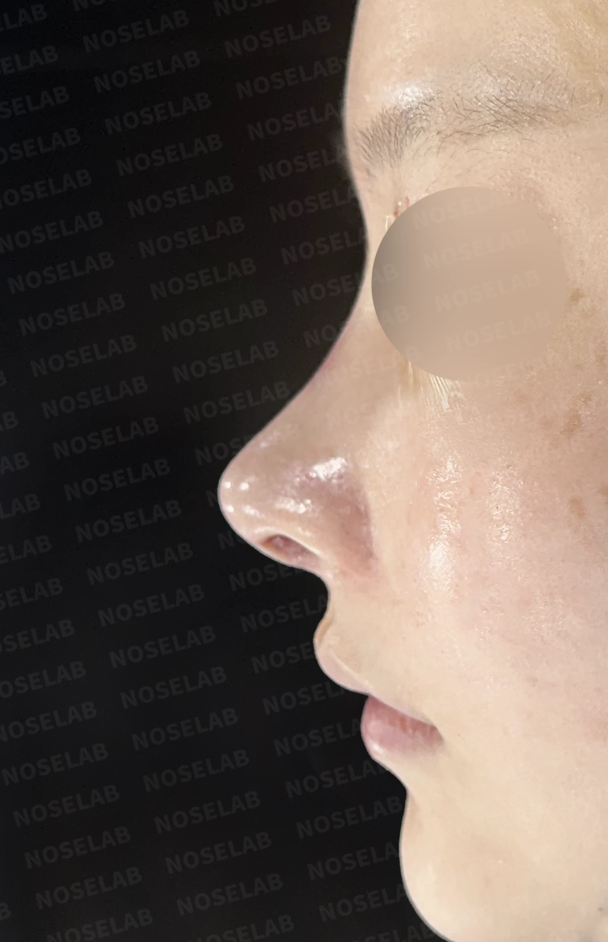 휘어진 코와 복코, 자가늑연골 비중격 재건으로 안전하게 교정한 코재수술 — 직후 정면, 비스듬한 측면, 측면 사진입니다.