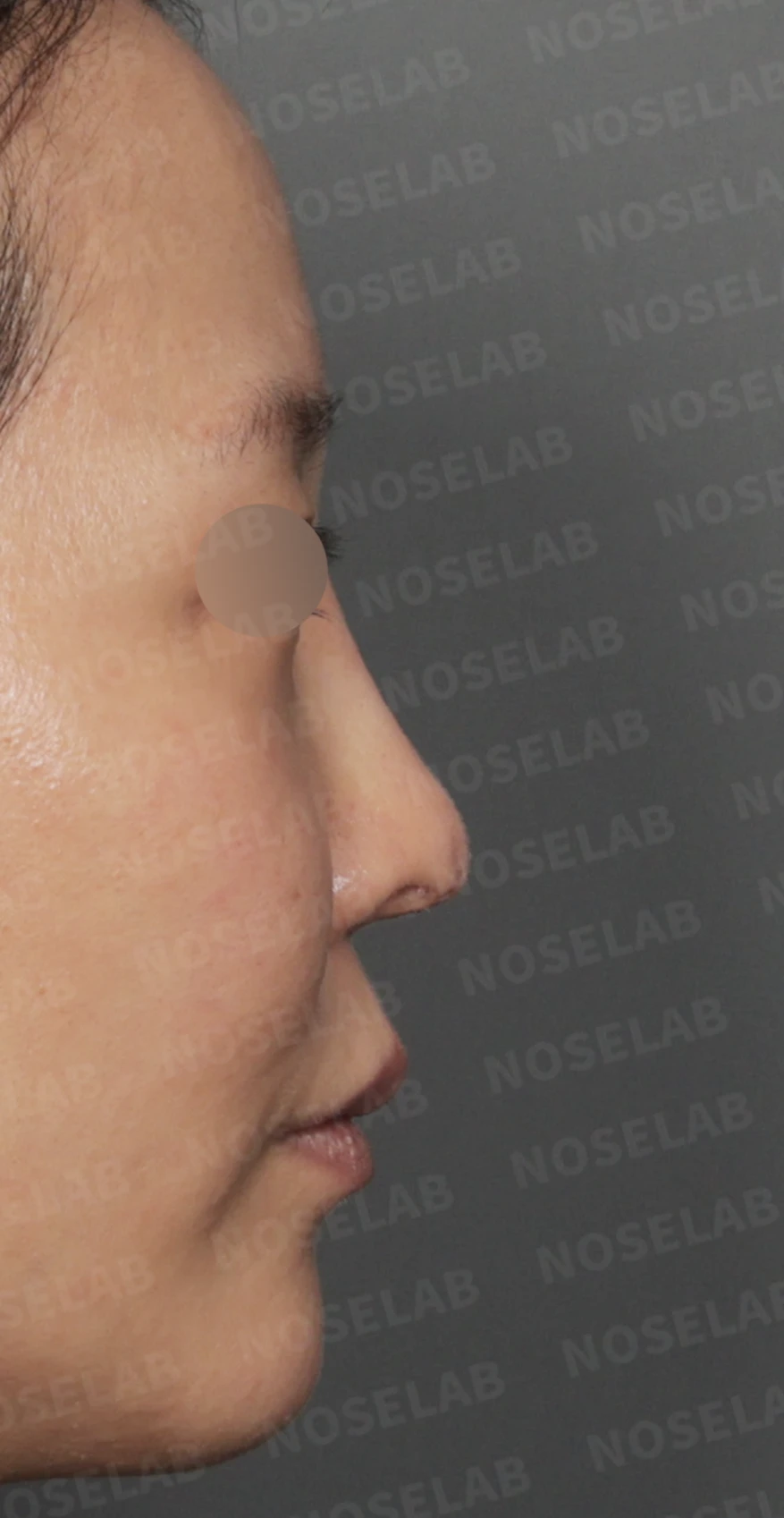 코끝 피부 함몰과 보형물 비침, 자가늑연골로 안전하게 복원한 코재수술 — 디자인 상담 — 우측 비스듬한 측면, 측면, 비공