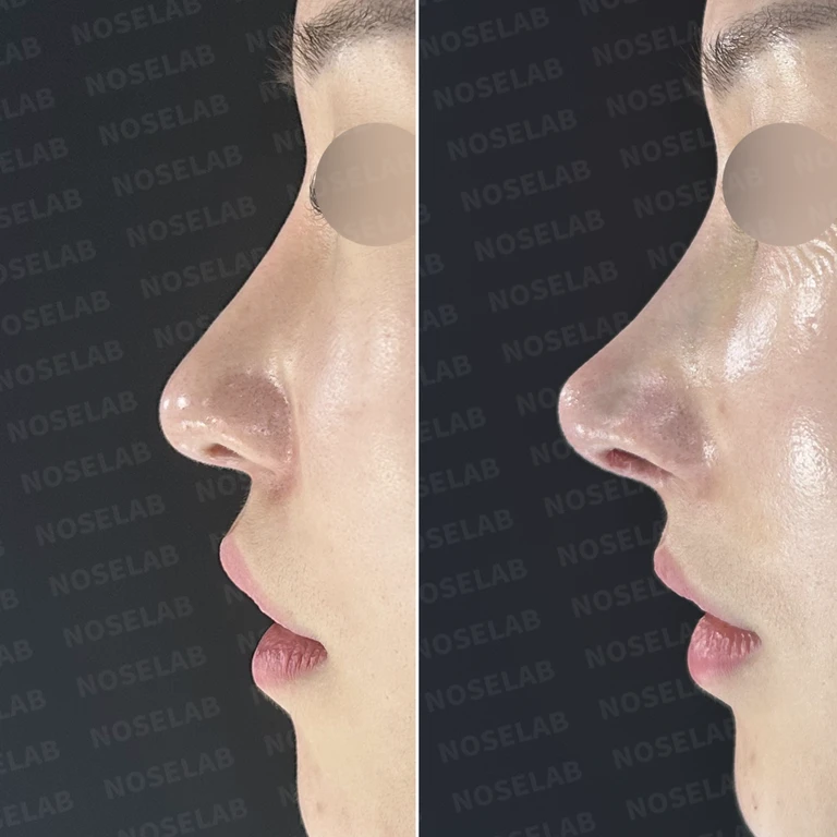 손상된 비중격 자가늑연골로 재건하고 코막힘까지 해결한 코재수술 — 전후 비교