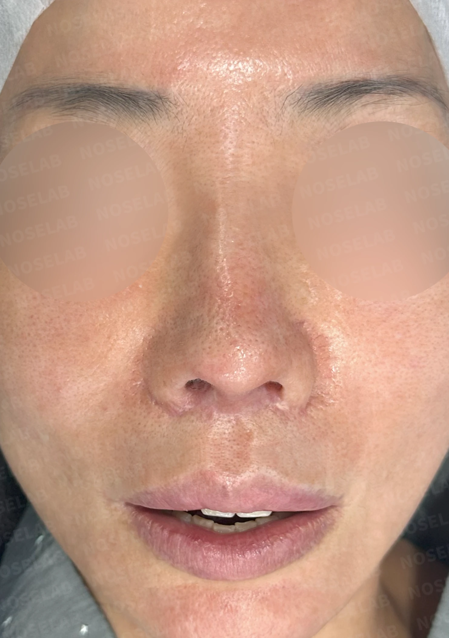 여러 차례 수술 뒤 비중격이 손상되면, 늑연골 재건은 어떻게 하나 — 수술 전 / 수술 직후 0일 직후 사진은 부기가 있는 상태로 최종 결과와 다를 수 있습니다.
