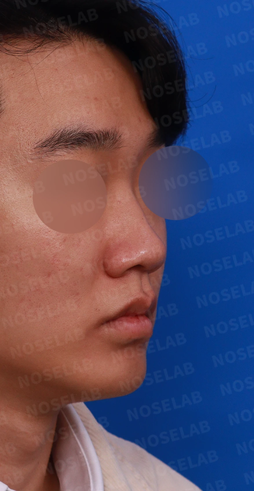 낮은 코와 코막힘을 함께 살펴보는 교정 방법 — 디자인 상담 우측 측면, 비스듬한 측면, 비공 사진