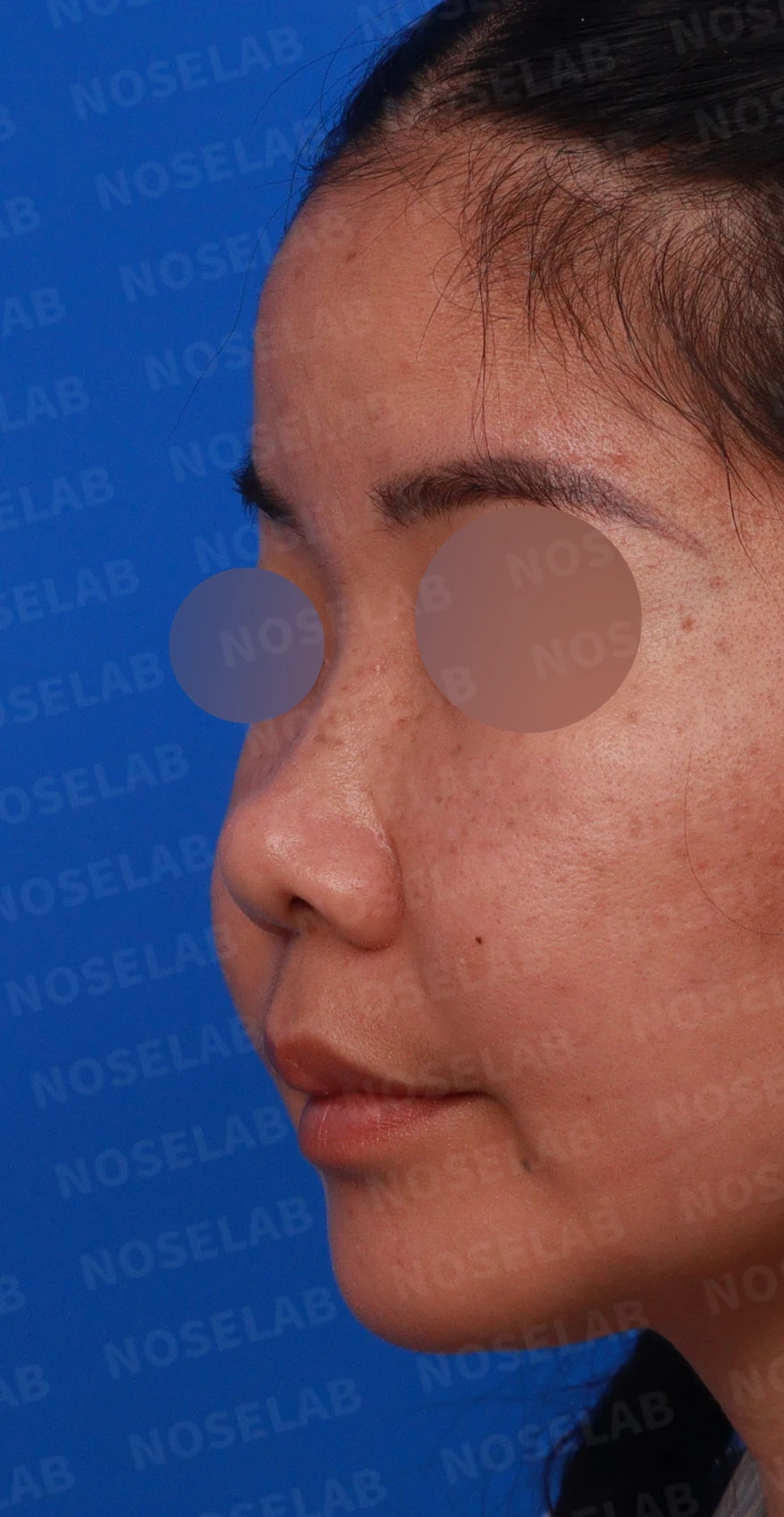콧대가 평행선처럼 보이는 조건과 콧구멍 모양을 정하는 기준 — 디자인 상담 정면 , 좌측 비스듬한 측면 , 측면 사진입니다.
