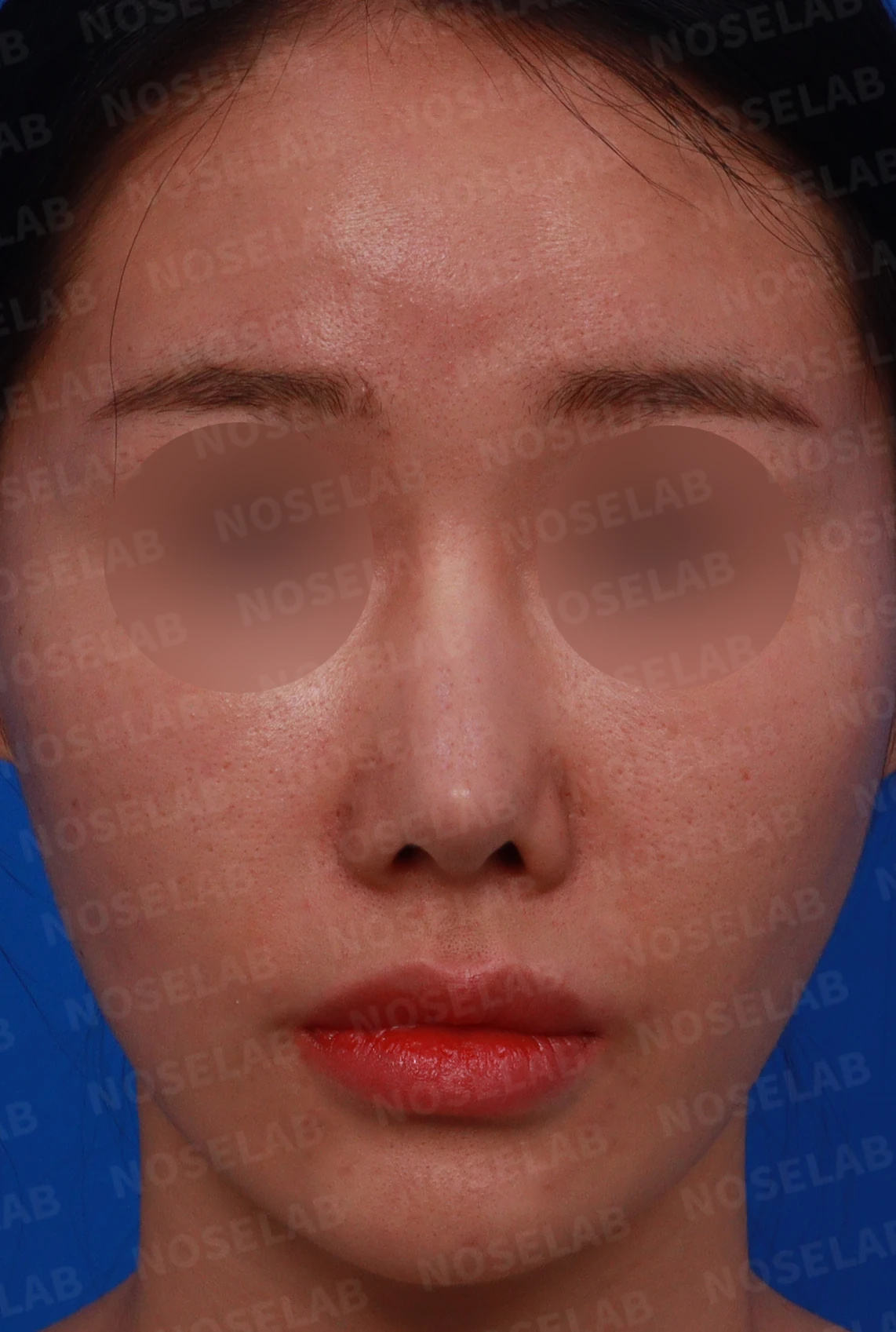 뾰족한 반버선코의 코끝과 콧대를 교정하는 방법 — 수술전 디자인 상담 정면, 우측 비스듬한 측면, 측면 사진입니다.