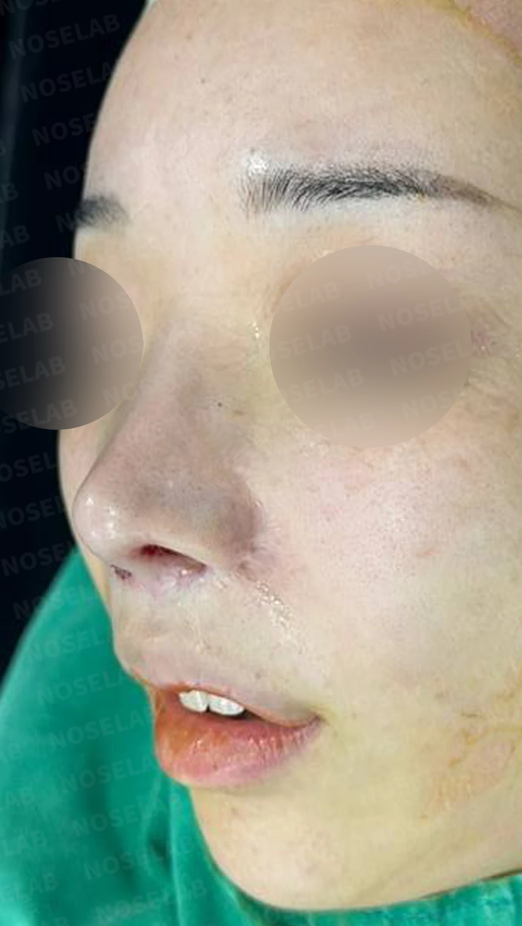 콧구멍 비대칭과 협착이 생기는 이유, 늑연골 재건과 Z성형은 어떻게 하나 — 수술 직후 0일 정면, 비스듬한 측면, 측면 사진입니다. 직후 사진은 부기가 있는 상태로 최종 결과와 다를 수 있습니다.