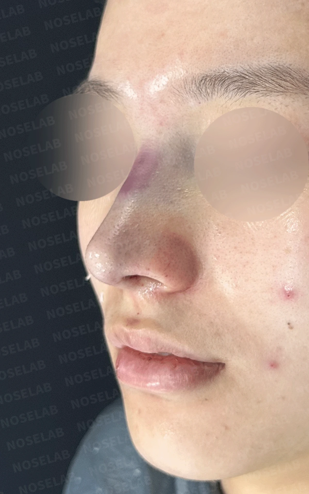 복코가 잘 교정되지 않는 이유와 이물질 제거 후 재건 방법 — 수술 직후 0일 정면 , 측면 , 비스듬한 측면 사진 직후 사진은 부기가 있는 상태로 최종 결과와 다를 수 있습니다.