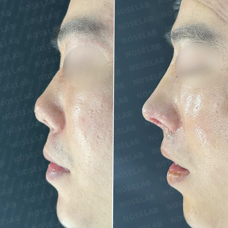 코끝 염증 재발 방지 재건술 - 찝힌 콧날개 교정 실제 후기 — 전후 비교