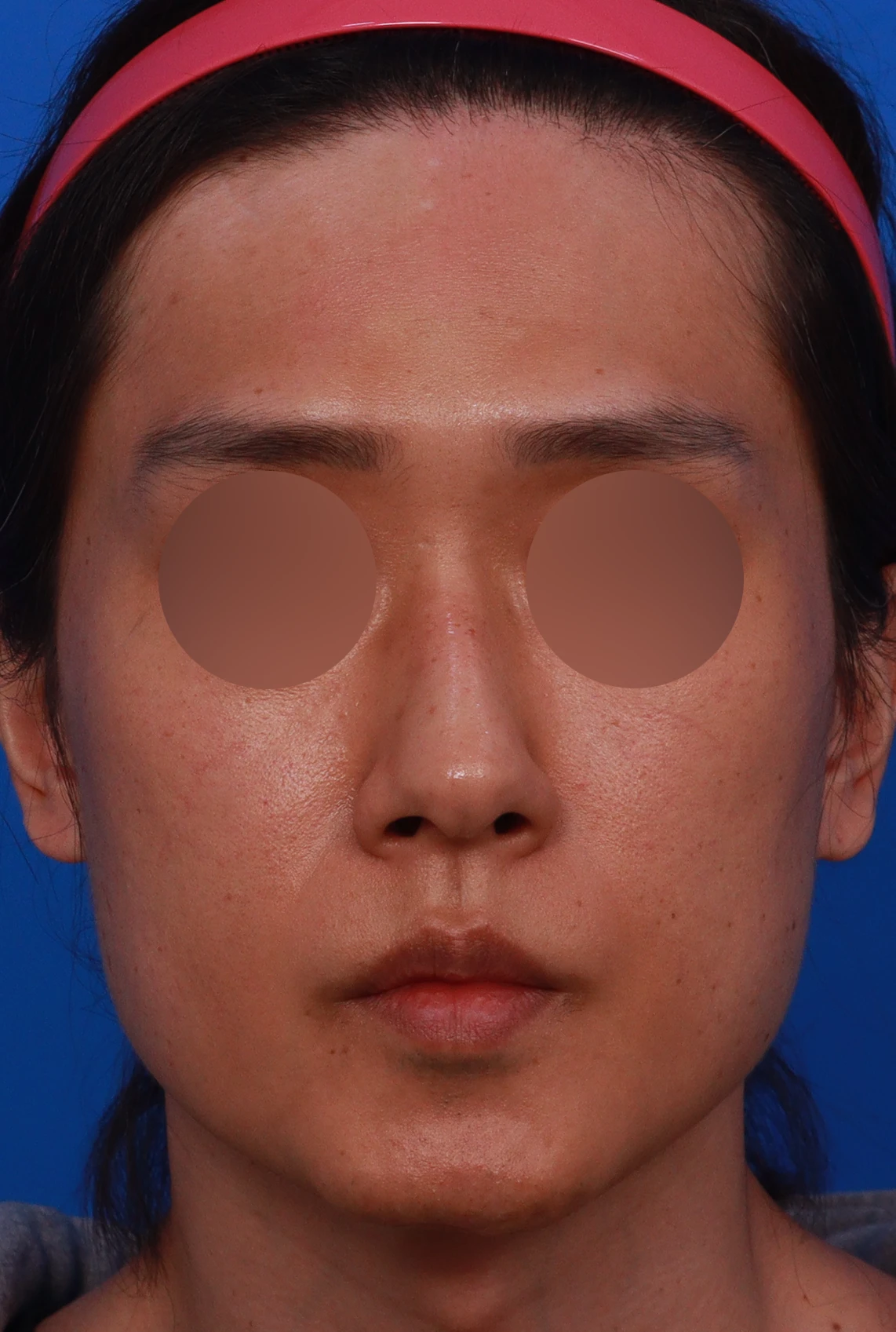 안면 비대칭이 있는 코에 맞춤형 보형물을 쓰는 이유와 매부리 교정 방법 — 디자인 상담 정면, 비스듬한 측면,좌측 측면 사진입니다.