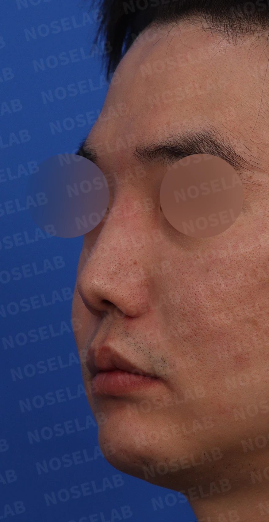 휜코와 콧구멍 비대칭을 함께 교정하는 방법 — 디자인 상담 사진 정면, 좌측 측면, 비스듬한 측면