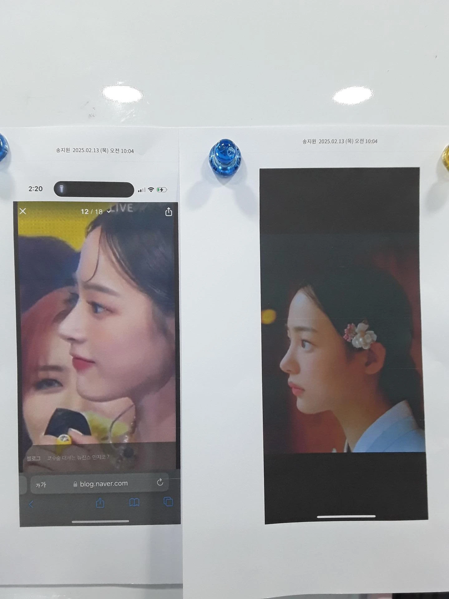 실리콘 보형물이 코끝 피부를 뚫고 나오려 할 때, 왜 생기고 어떻게 재건하나 — 본문 사진 9