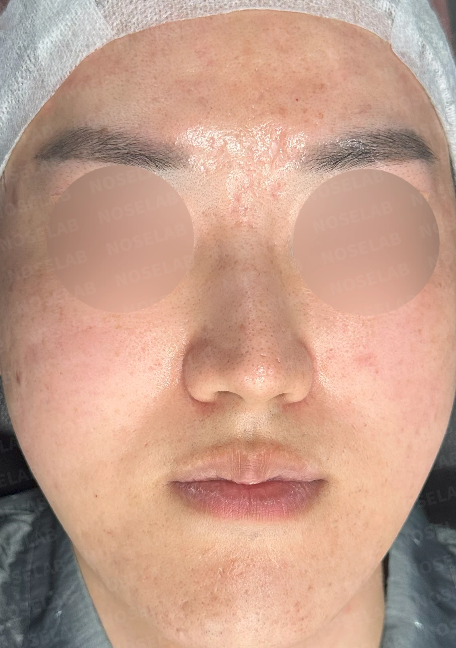 보형물 없이 코끝과 경계 부분만 교정하는 방법 — 수술 전 / 수술 직후 0일 직후 사진은 부기가 있는 상태로 최종 결과와 다를 수 있습니다.