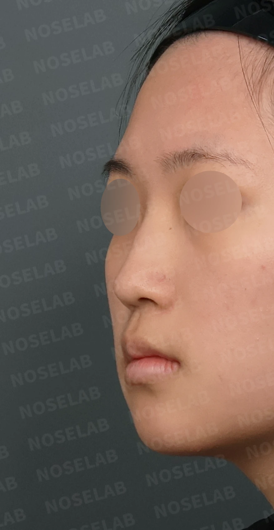 작은 콧날개 연골과 처진 코끝, 자가늑연골과 외측절골술로 자연스럽게 교정 — 디자인 상담 정면, 좌측 측면, 비스듬한 측면 사진입니다.