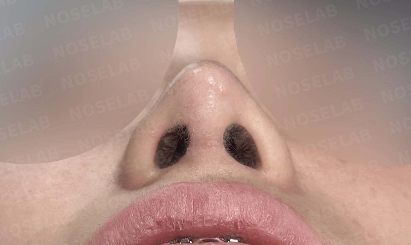 자가 늑연골 코재수술, 콧대부터 코끝까지 슬림하고 여성스럽게 — 전(좌) 직후(후)