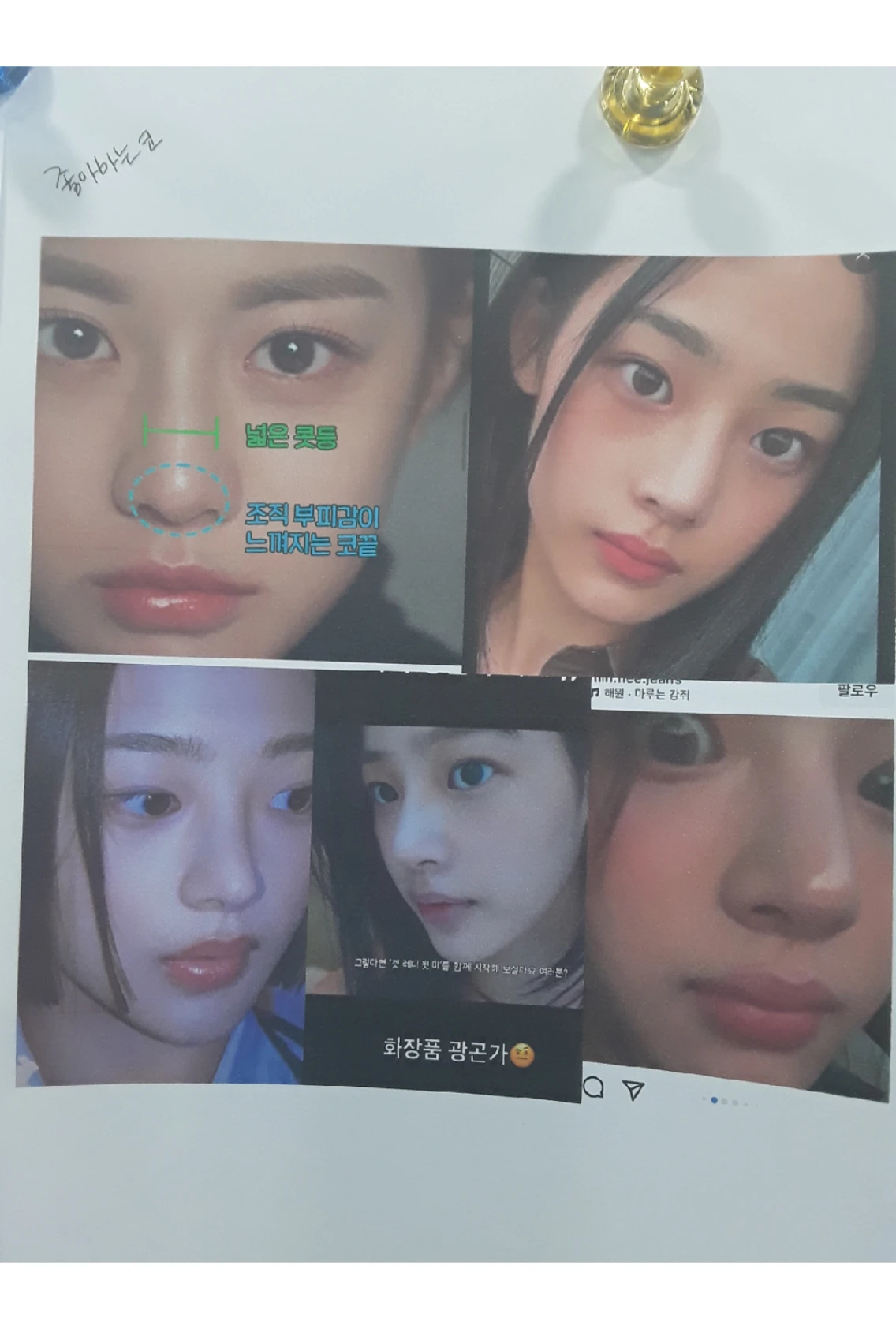 이식한 진피가 반복해서 흡수되는 이유, 재건은 어떻게 하나 — 1. 환자분이 좋아하는 코 2. 환자분이 싫어하는 코