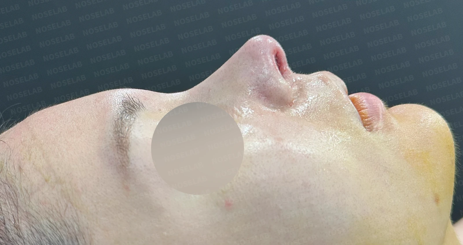 여러 코 모양 고민을 함께 살펴보는 코성형 계획 — 수술 전 / 수술 직후 0일 직후 사진은 부기가 있는 상태로 최종 결과와 다를 수 있습니다.