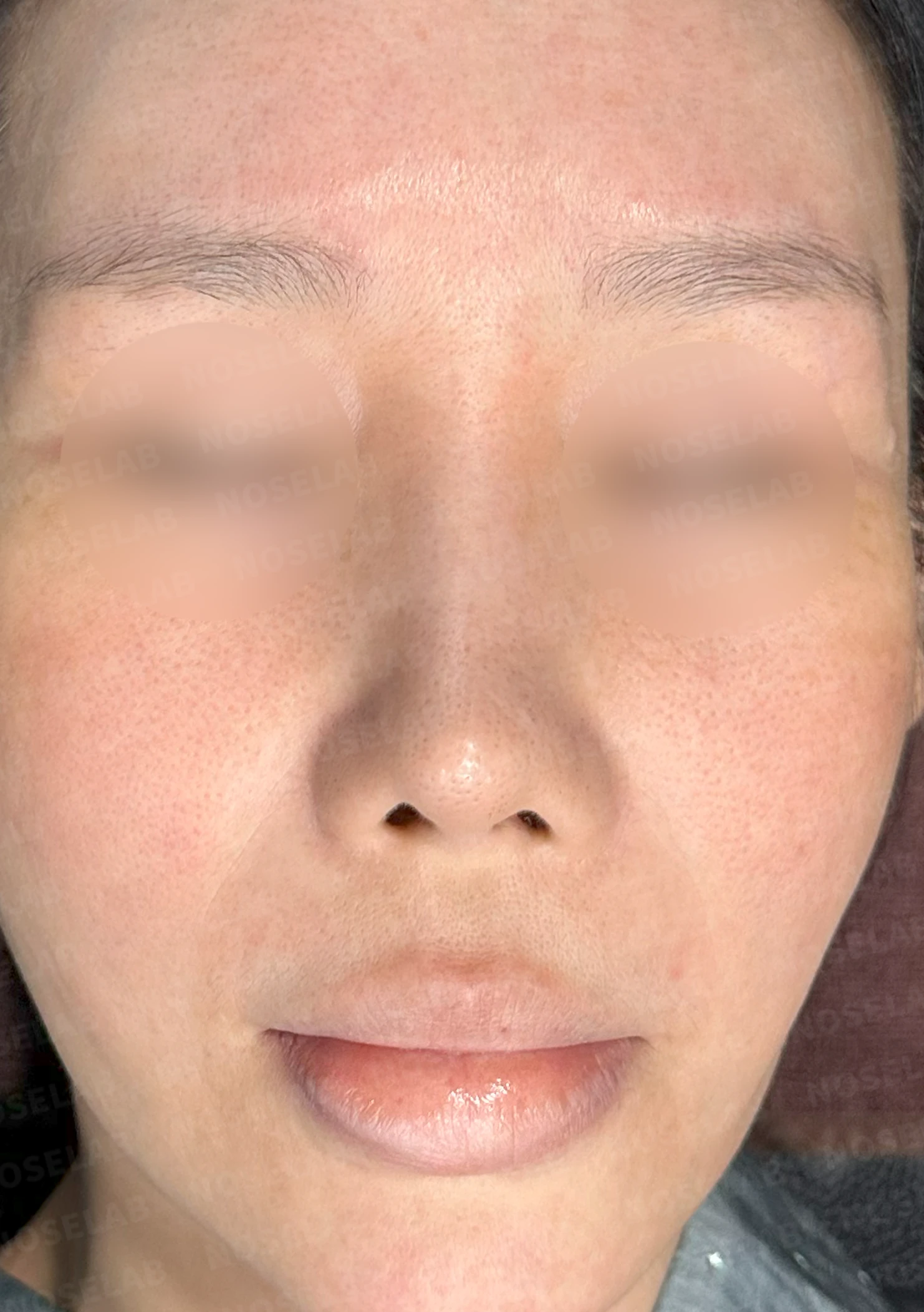 들린 코와 휜코를 함께 교정하는 재수술 방법 — 수술 전 / 수술 직후 0일 직후 사진은 부기가 있는 상태로 최종 결과와 다를 수 있습니다.