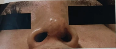 콧구멍을 막는 종괴가 생기는 이유, 제거와 재건은 어떻게 하나 — 본문 사진 8