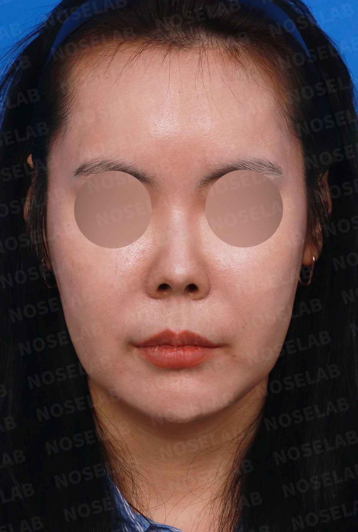 L자 실리콘 보형물이 비주 점막을 뚫기 직전까지 가는 이유, 제거와 자가늑연골 재건 방법 — 디자인 상담 정면, 좌측 측면, 비스듬한 측면 사진