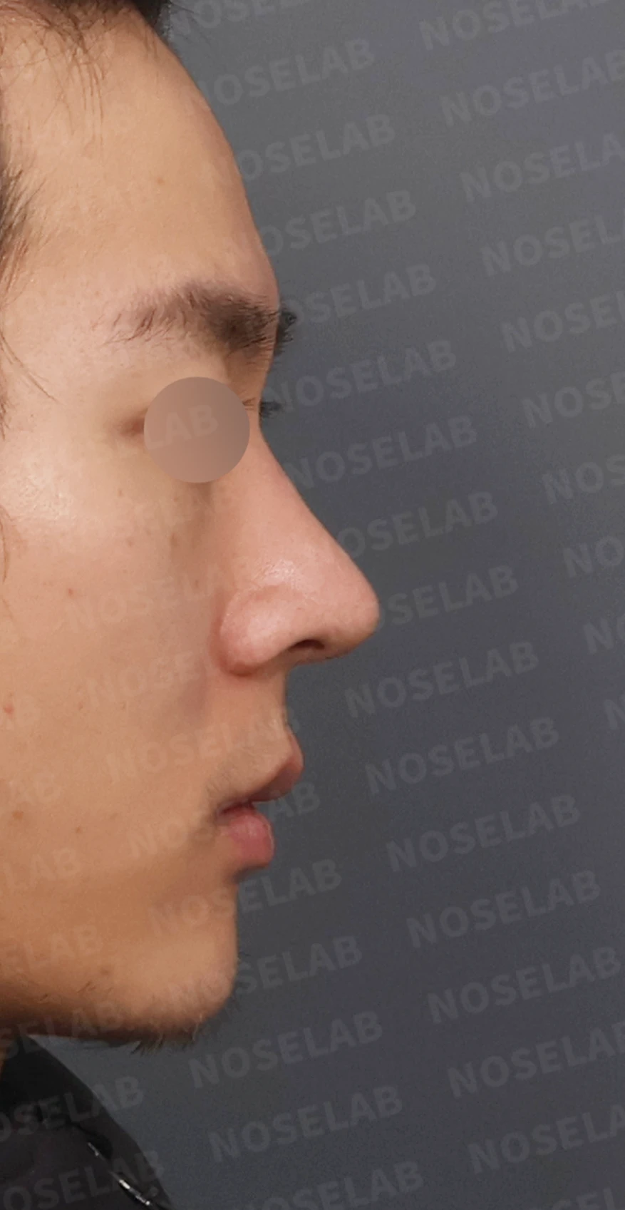 짧고 들린 코, 자가늑연골로 남성적인 라인으로 완성한 코재수술 — 디자인 상담 우측 비스듬한 측면, 측면, 비공 사진입니다.