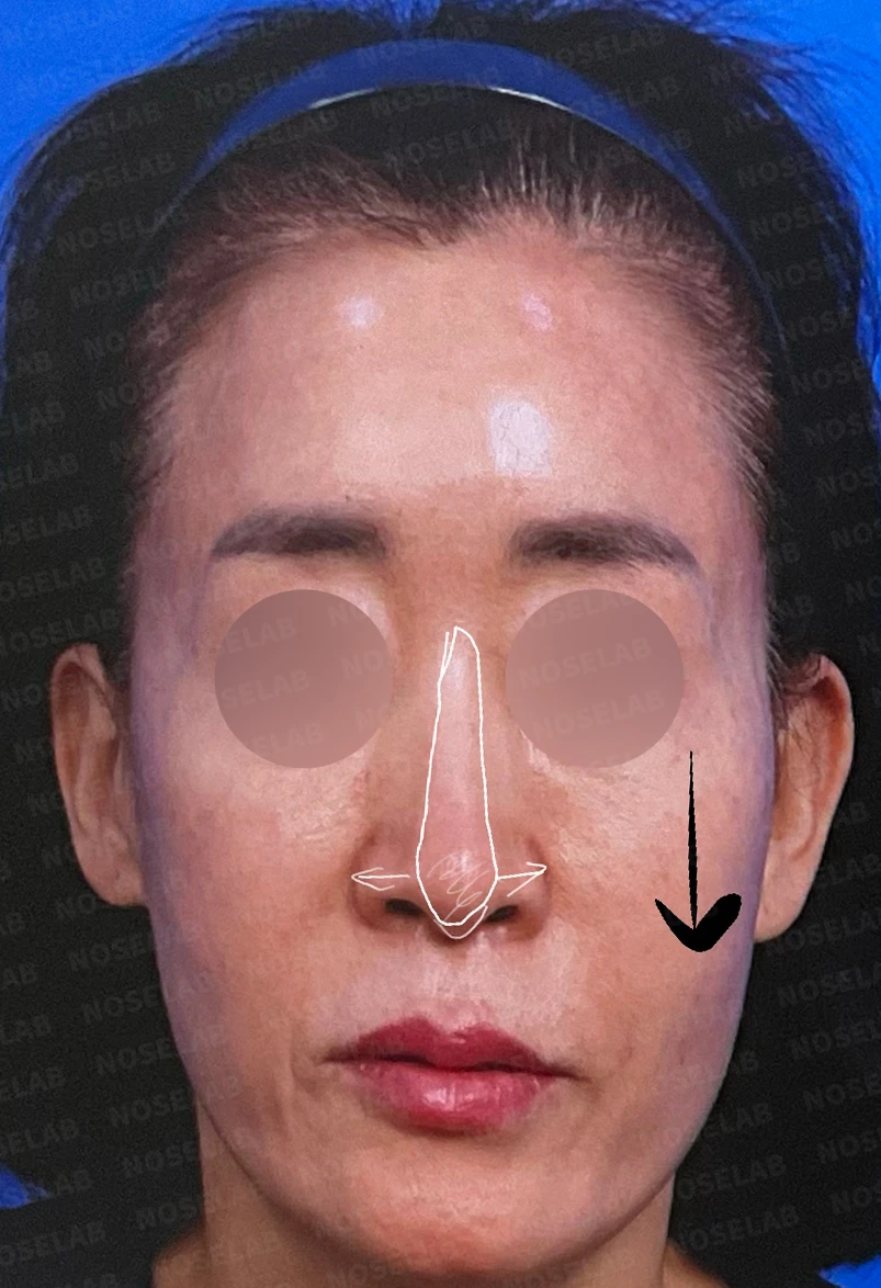 화살코, 긴코 교정 방법 — 수술전 디자인 상담 정면 사진입니다.