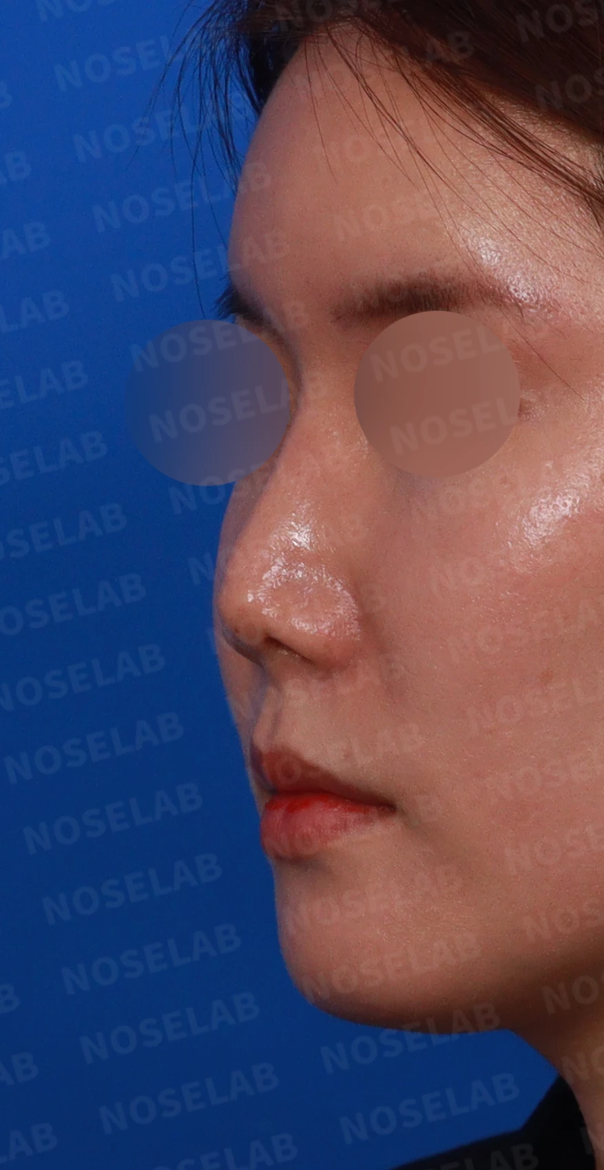 기증 늑연골이 흡수되면 코가 어떻게 변하고, 자가 늑연골 재건은 어떻게 하나 — 디자인 상담 정면 , 비스듬한 측면 사진, 좌측 측면