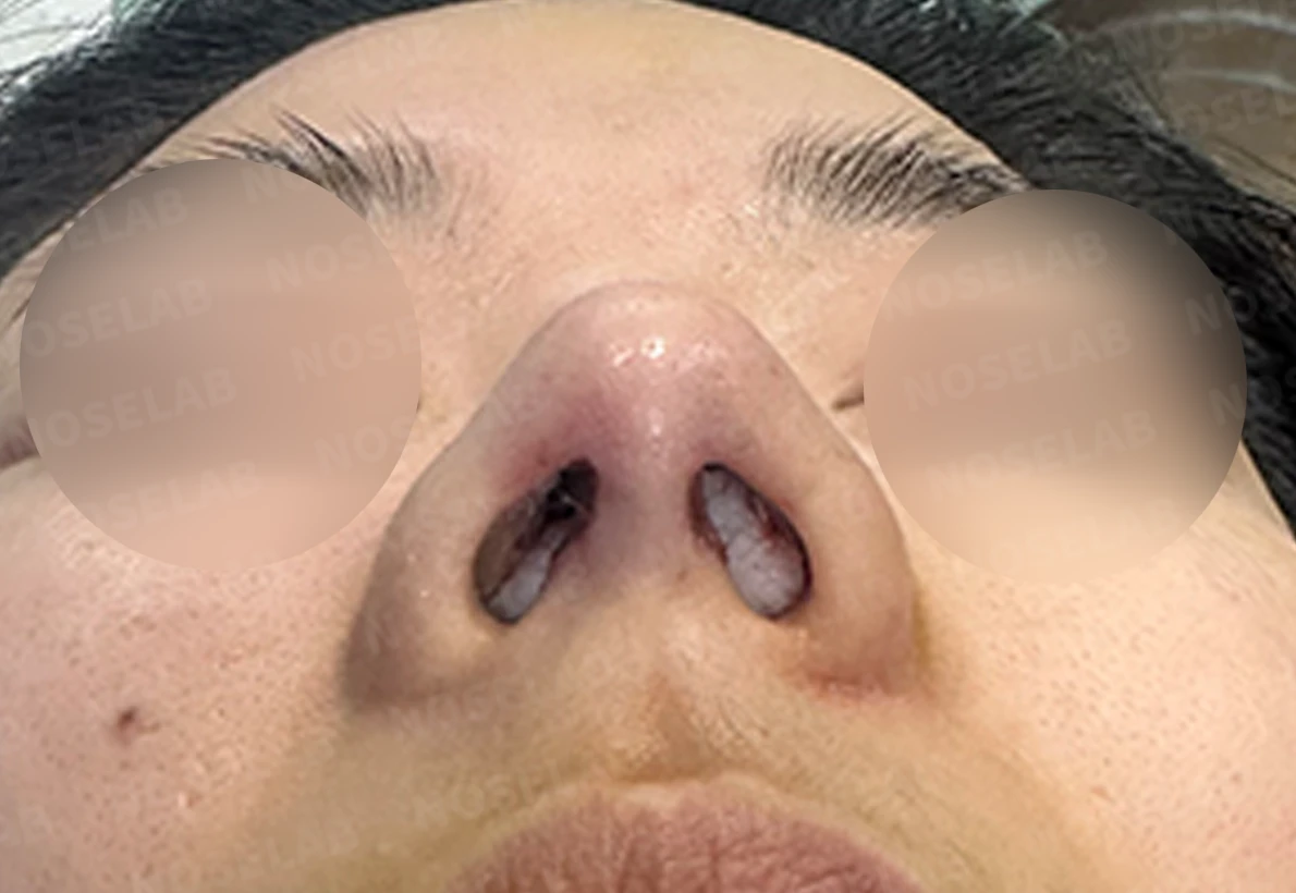 복코 수술은 어떻게 하나요? — 수술 전 / 수술 직후 0일 직후 사진은 부기가 있는 상태로 최종 결과와 다를 수 있습니다.