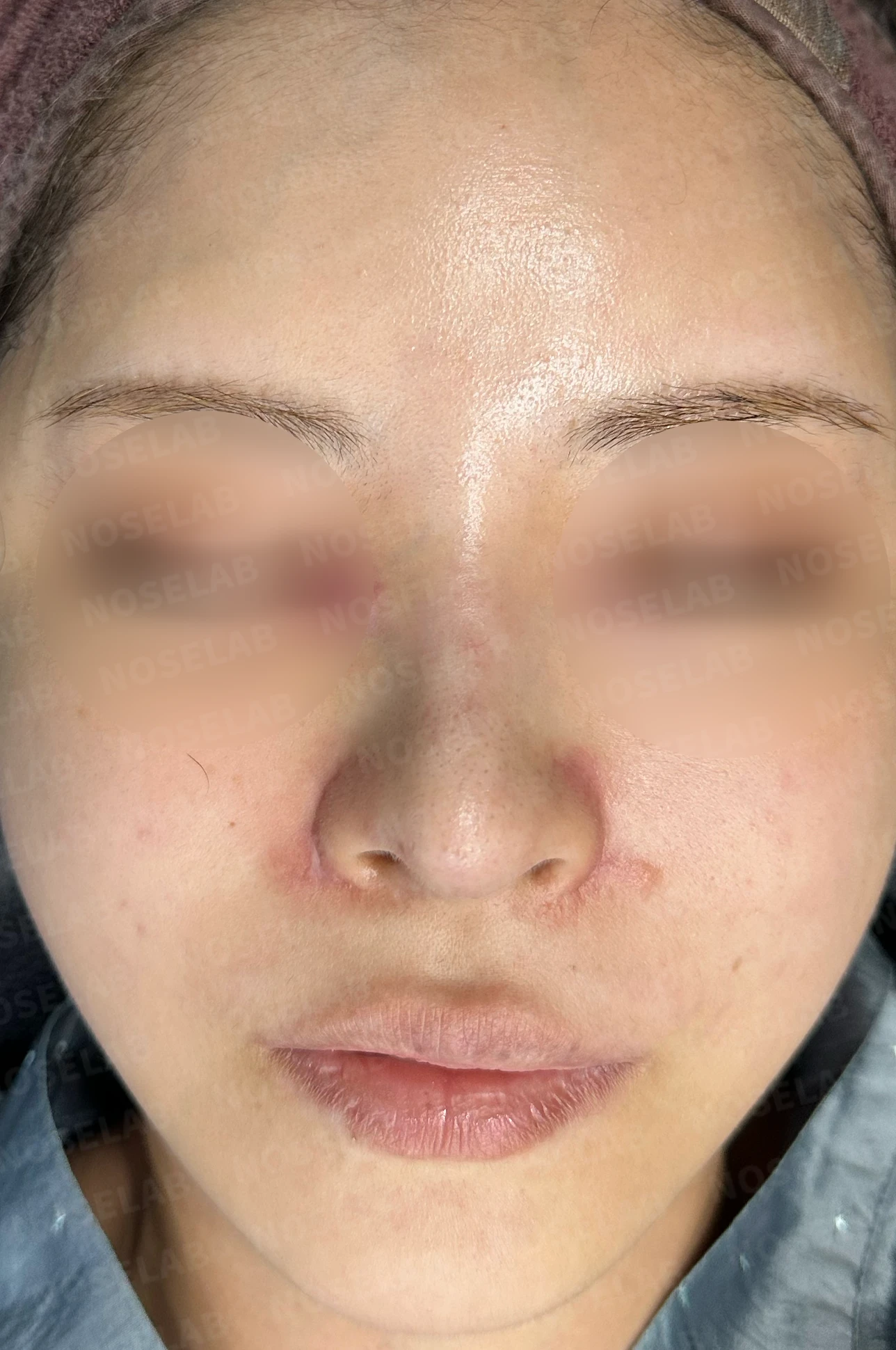 들린코, 휜코 교정 코성형 사례 — 전(좌) 직후(우)