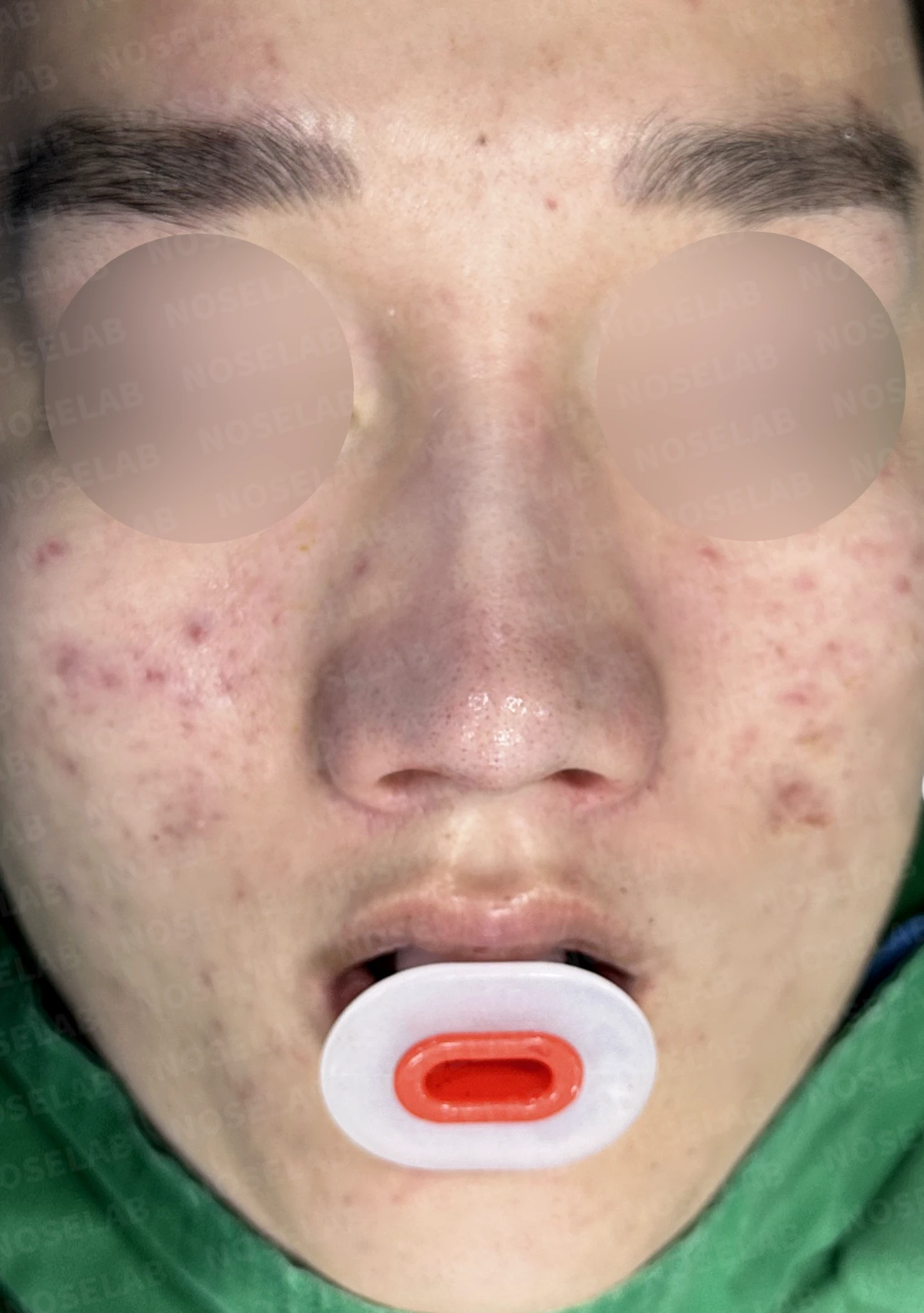 휜코 매부리코 교정, 남자 코성형으로 자연스러운 변화 — 전(좌) 직후(후)