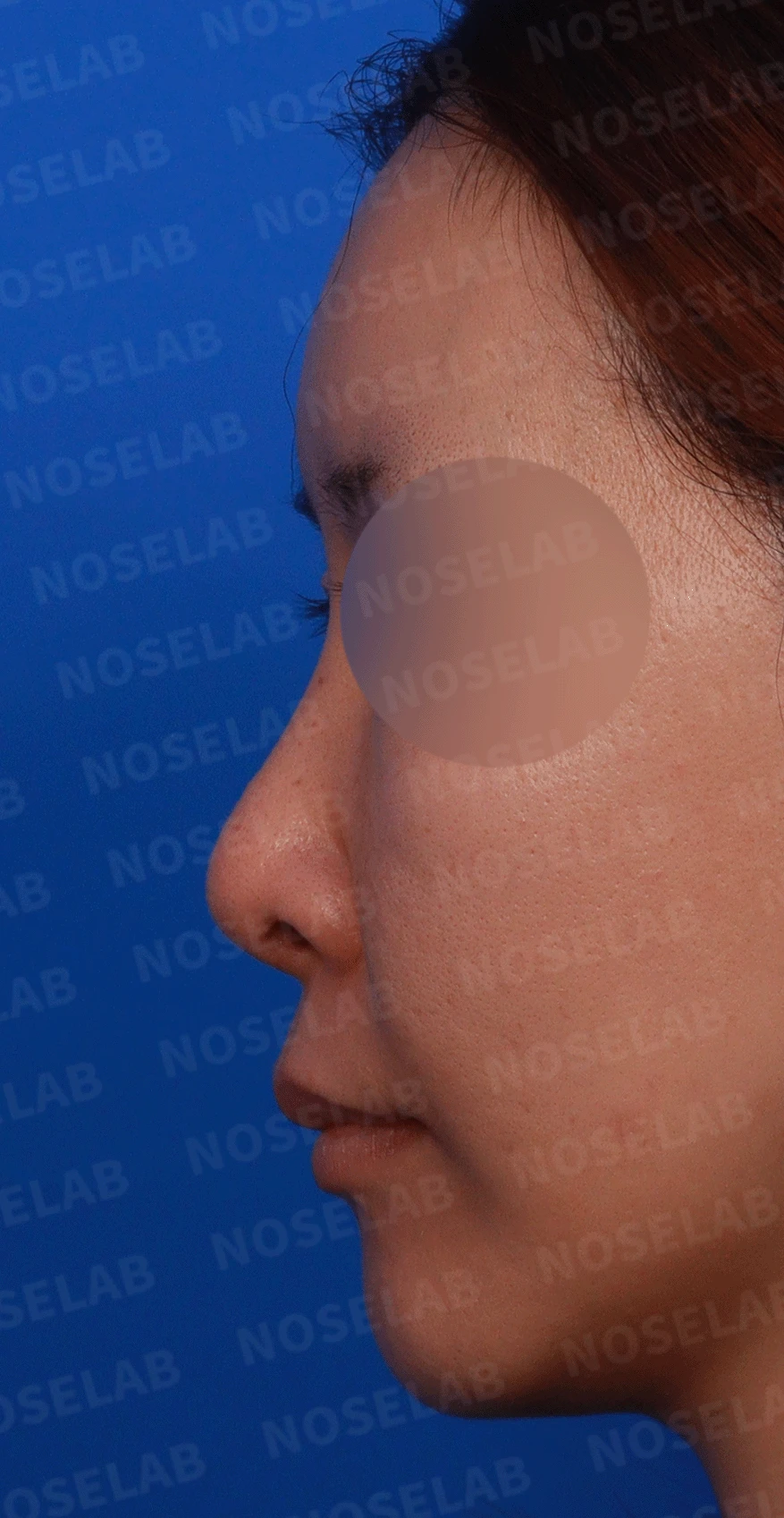 후비루와 코끝 처짐이 함께 나타나는 이유, 비중격 연장과 기능 수술은 어떻게 하나 — 디자인 상담 정면 , 좌측 측면 ,비스듬한 측면 사진