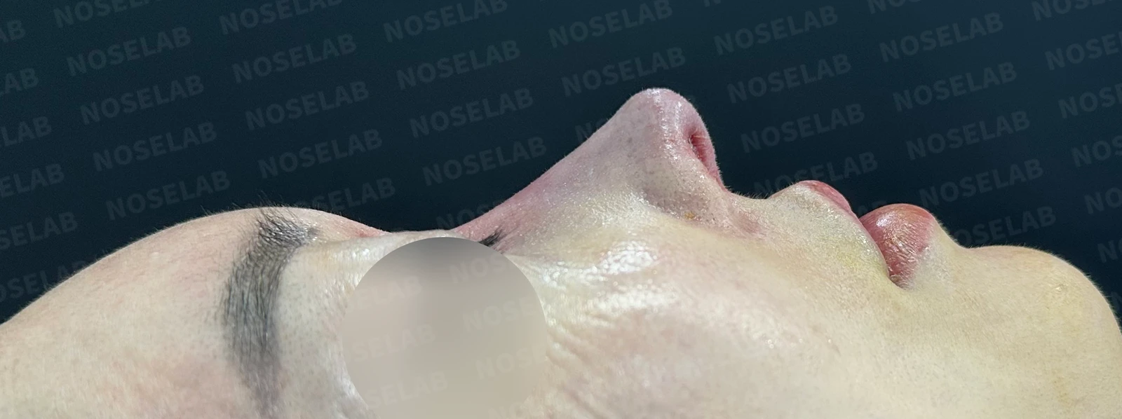 긴코 교정은 어떻게 할까요? — 수술 전 / 수술 직후 0일 직후 사진은 부기가 있는 상태로 최종 결과와 다를 수 있습니다.