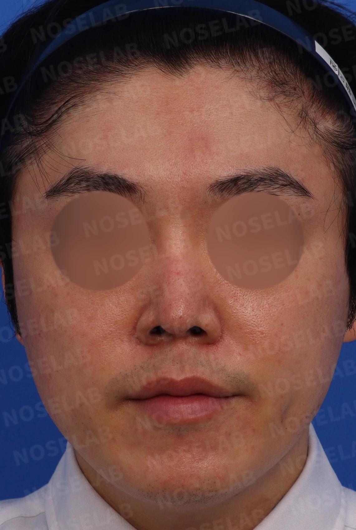 비중격연골 손상으로 무너진 코 수술 방법 — 수술전 디자인 상담 위해 촬영한 사진입니다. 정면, 비스듬한 측면, 측면