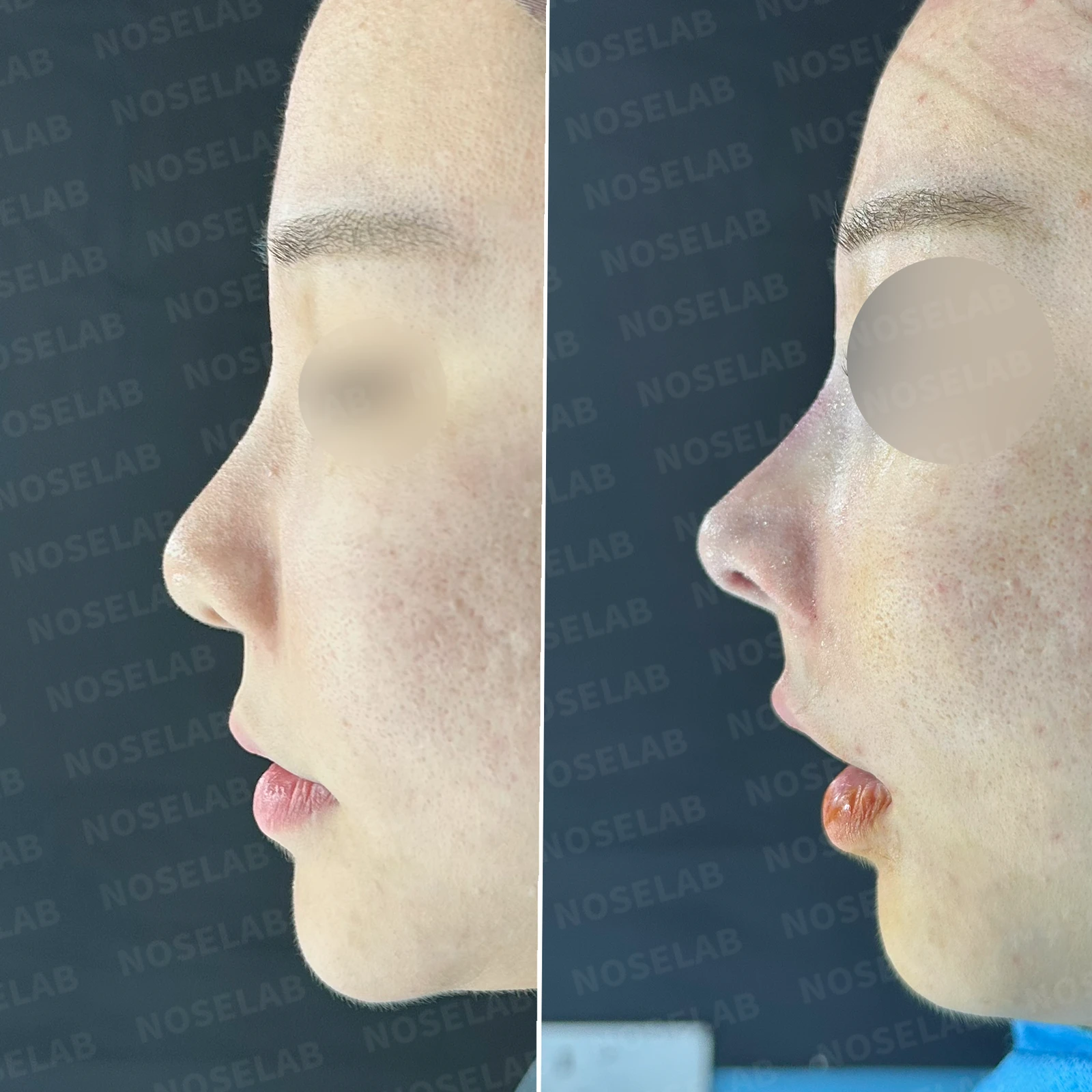 필러와 실 시술 뒤 코가 뭉툭해지는 이유, 이물질 제거와 코끝 교정 방법 — 본문 사진 26