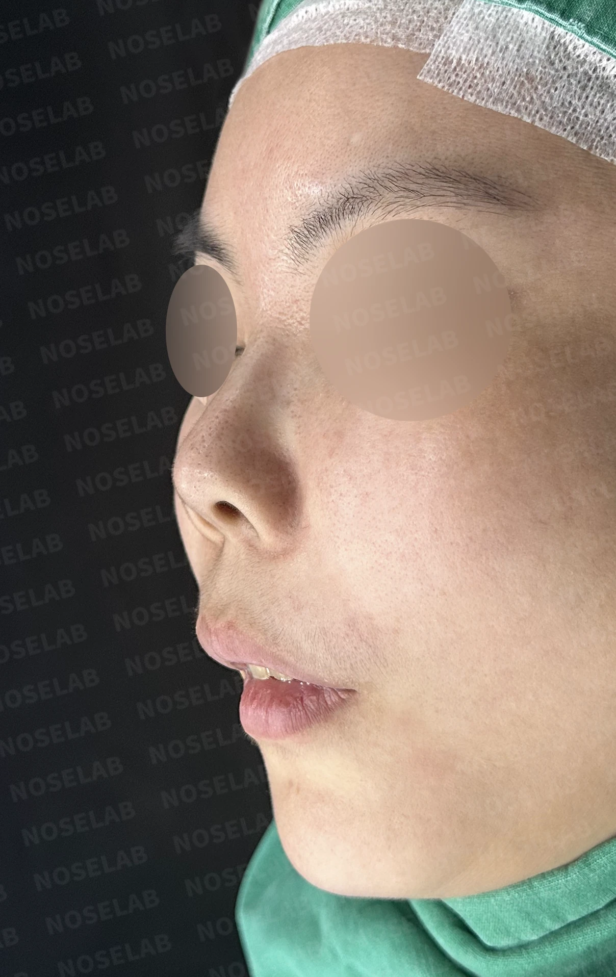 L자 실리콘 보형물이 비주 점막을 뚫기 직전까지 가는 이유, 제거와 자가늑연골 재건 방법 — 수술 전 / 수술 직후 0일 직후 사진은 부기가 있는 상태로 최종 결과와 다를 수 있습니다.