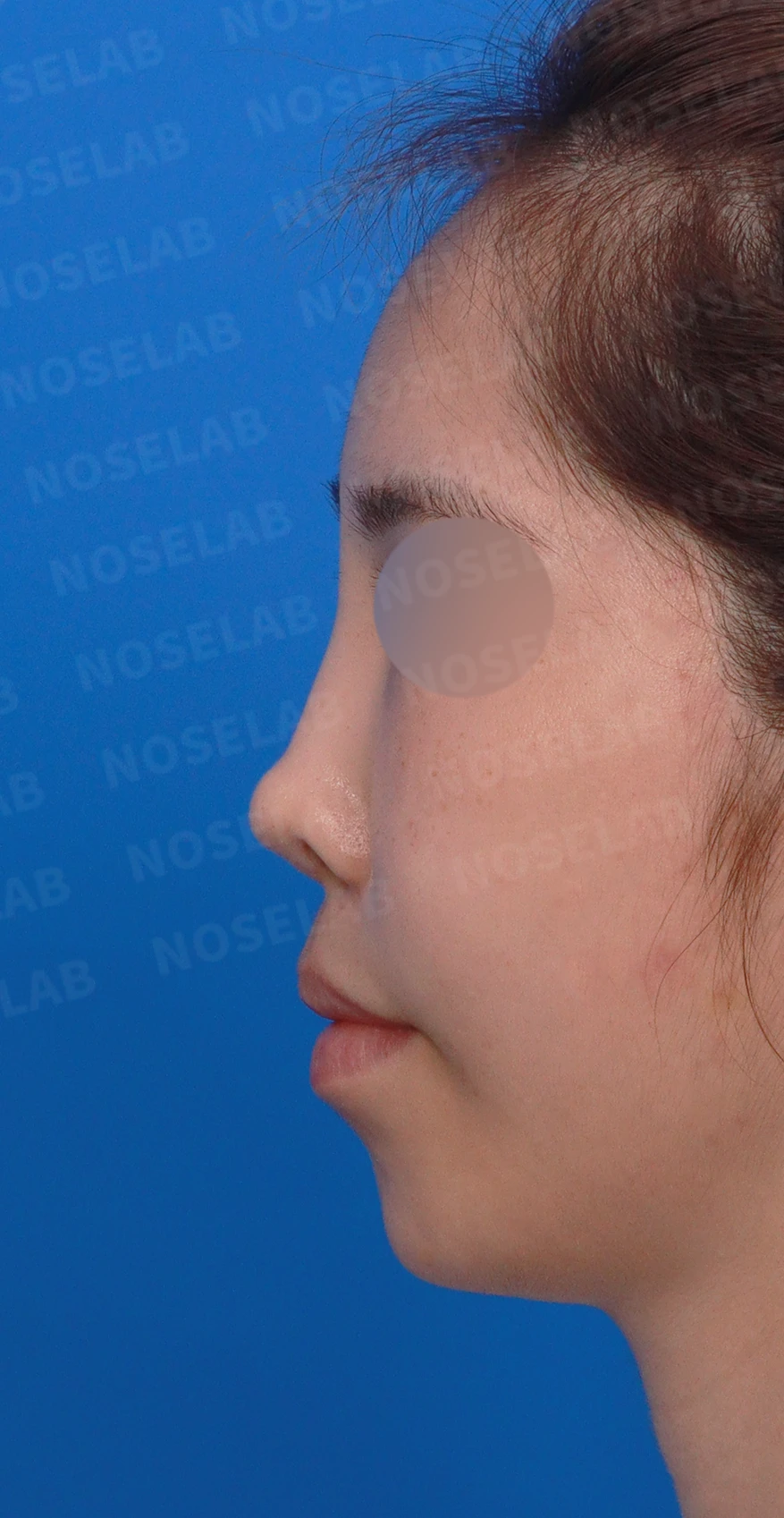 보형물을 넣고 빼기를 반복한 코에 남는 콧등 패임과 들린 느낌 — 디자인 상담 정면 , 좌측 비스듬한 측면 , 측면 사진입니다.