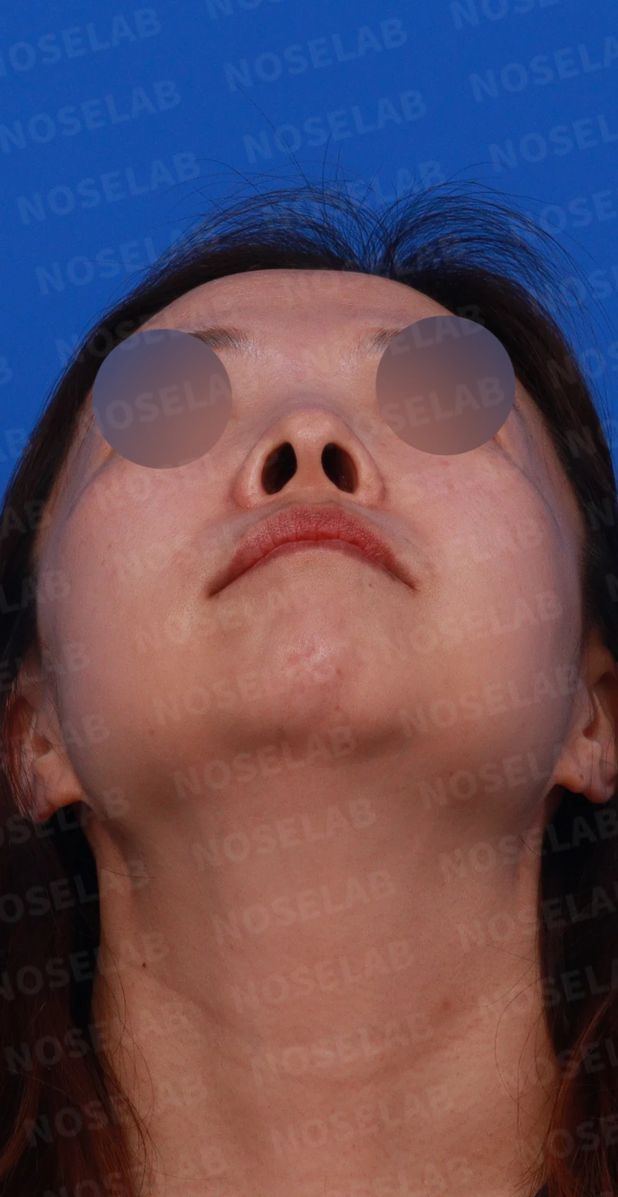 들창코에서 콧구멍이 많이 보이는 이유, 코끝 위치 교정은 어떻게 하나 — 디자인 상담 우측 비스듬한 측면, 측면, 비공 사진