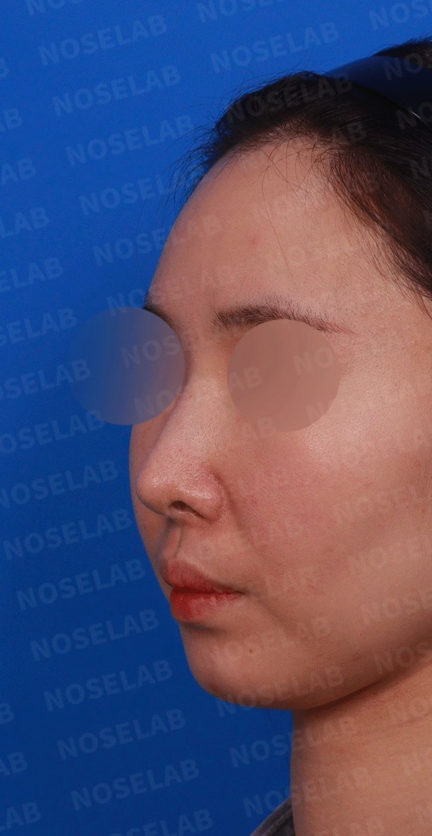코성형 절골 후 콧등이 꺼지고 한쪽이 막히는 이유, 비밸브 재건과 복원 — 디자인 상담 정면 , 좌측 비스듬한 측면 , 측면 사진입니다.