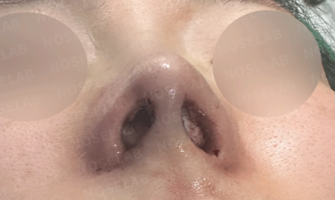 매부리코와 휜 코에 코막힘이 함께 오는 이유, 복합 교정은 어떻게 하나 — 본문 사진 14