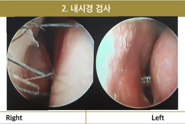 찝힌코, 콧구멍 비대칭 교정 방법 — 비중격이 우측으로 편위 되어있는 코 내시경 사진입니다.